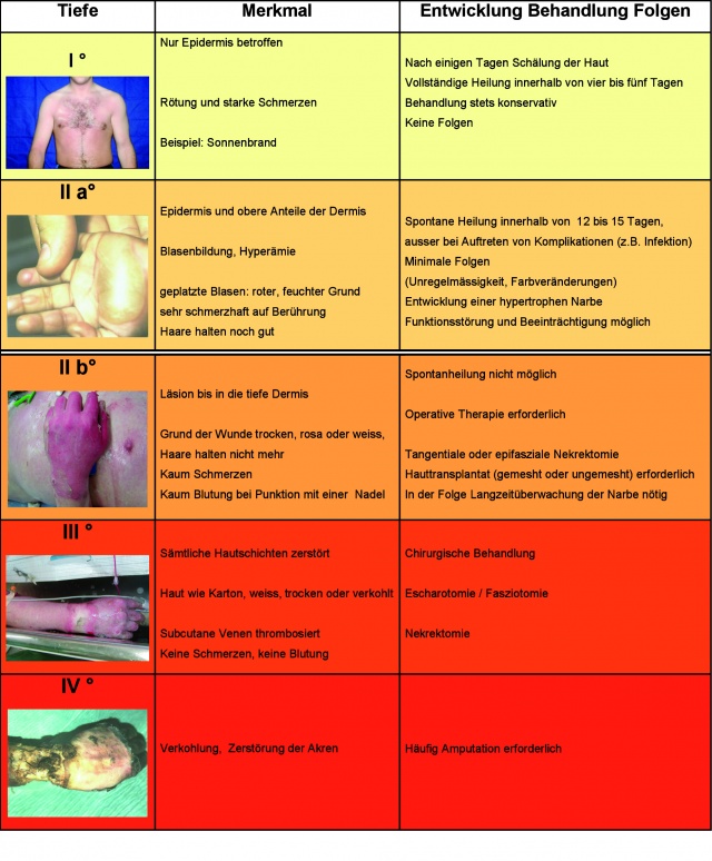 How To Care For A Second Degree Burn Wound Burns Sepsis Alliance / Do