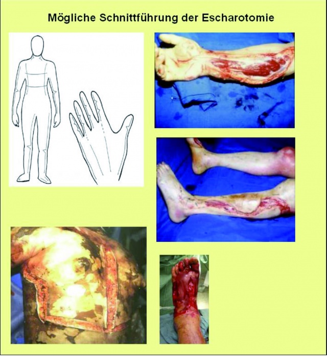 burn debridement