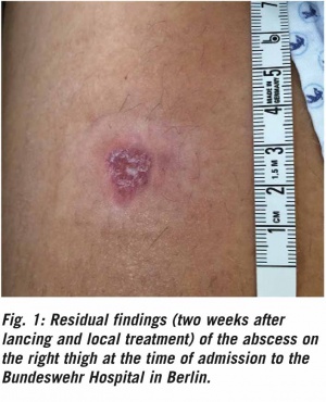 Infectious Spondylitis Military Medicine Worldwide