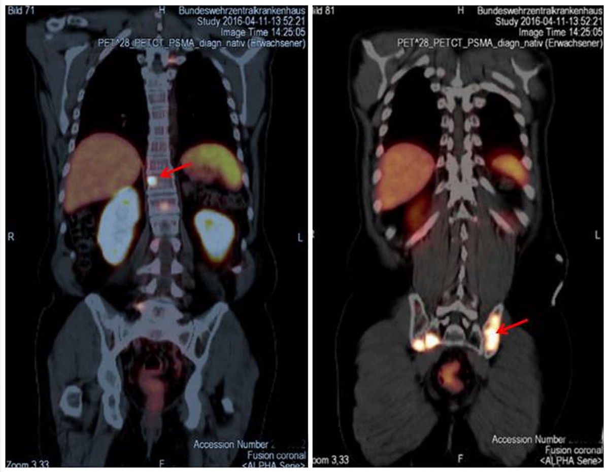 The Role of PSMA PET/CT and PET/MRI in Diagnosing Prostate Carcinoma