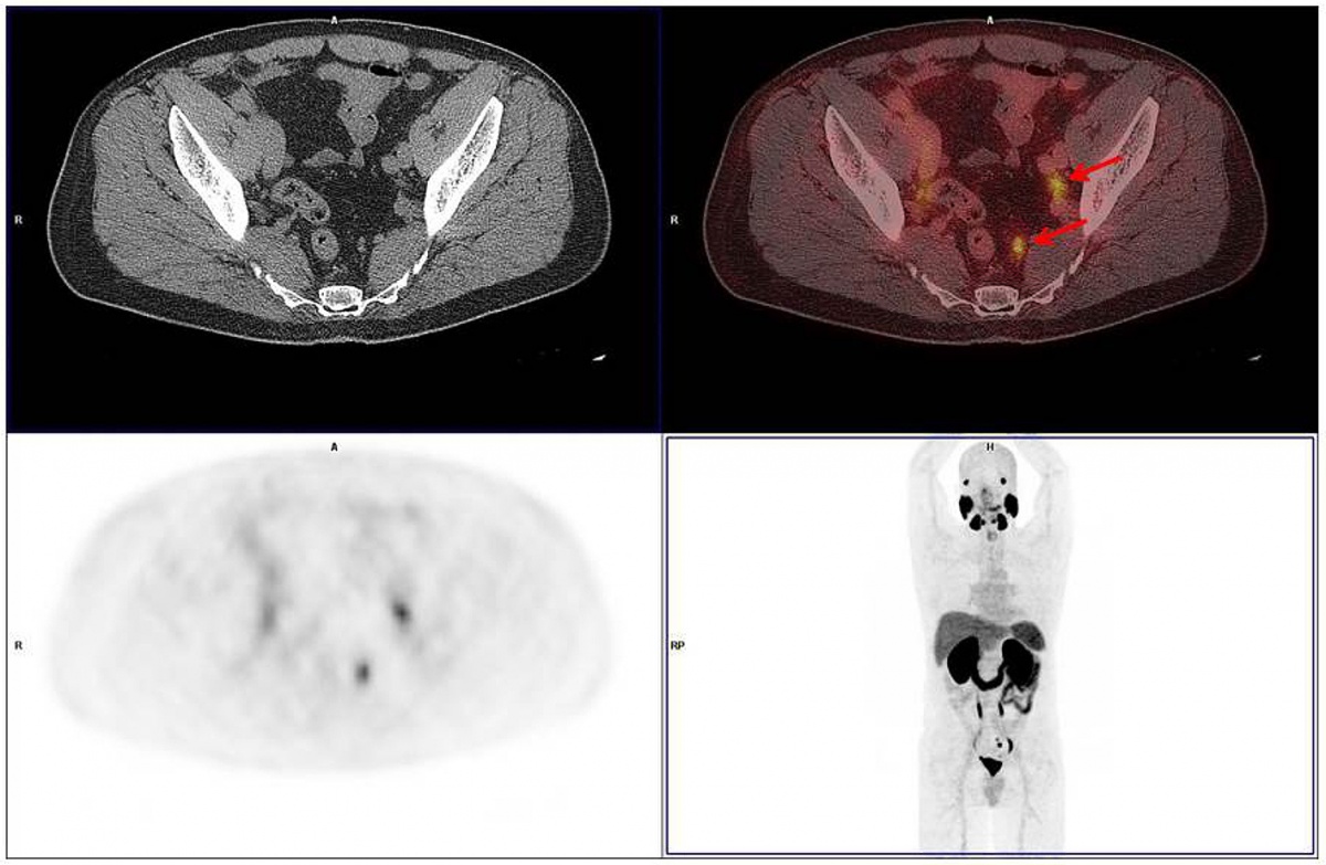 Prostata adenom diagnostika mrt počítač