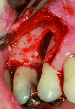 periodontal emergency treatment in the field