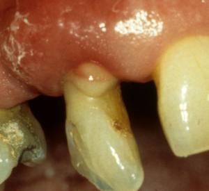 purulent exudate teeth