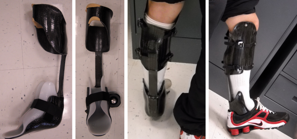 Lower Extremity Prosthetics, Westcoast Brace and Limb