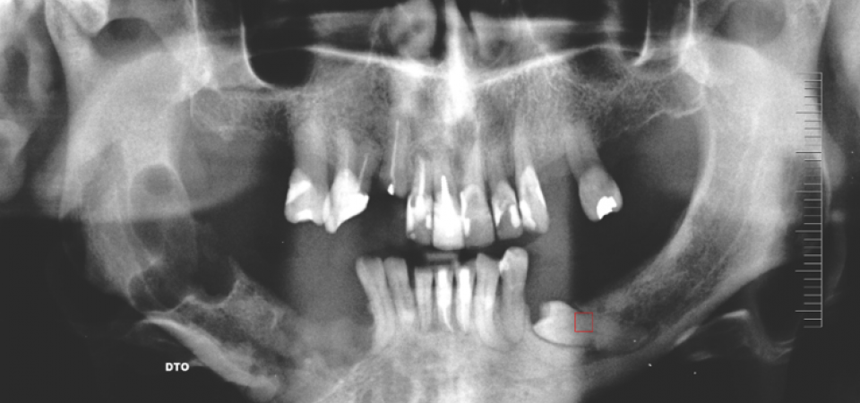 Surgical Approach of a Dentigerous Cyst