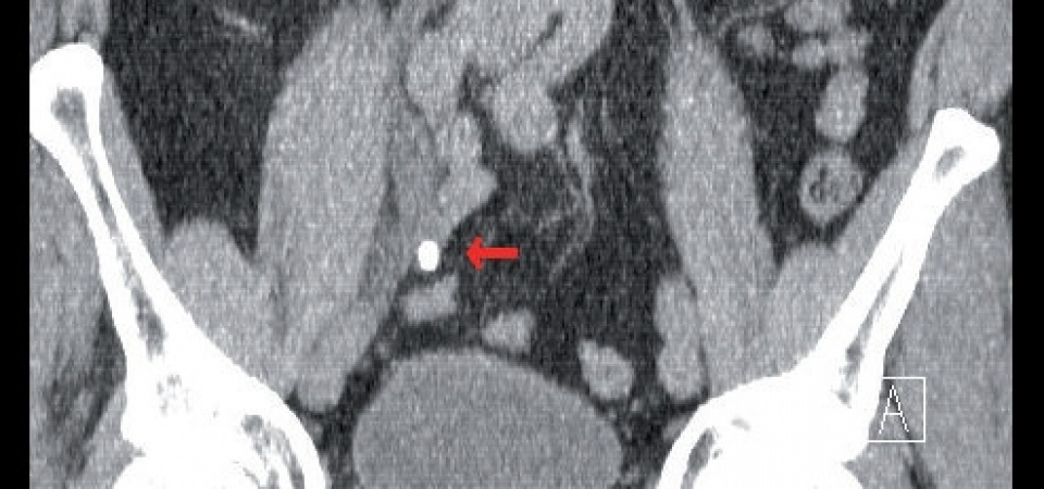 Modern Urological Therapy of Calculi during Deployment