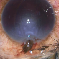 Splinter injury to the eye from grenade burst in training ground – our experience of management and recommendation to save valuable eyes
