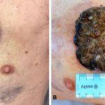 Befund eines fortgeschrittenen malignen Melanoms bei Erstvorstellung des Patienten (A) Übersicht mit Umgebung, (B) Detailansicht mit Maßstab