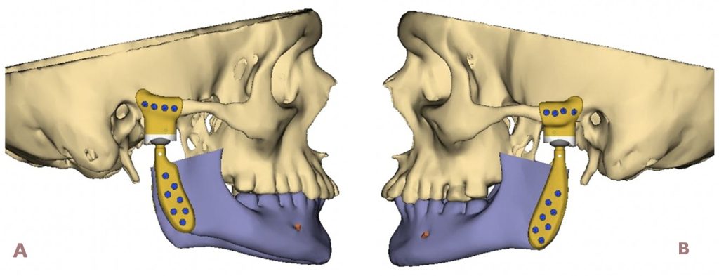 Kiefergelenksrekonstruktion