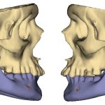 Kiefergelenksrekonstruktion