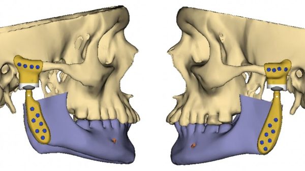 Kiefergelenksrekonstruktion