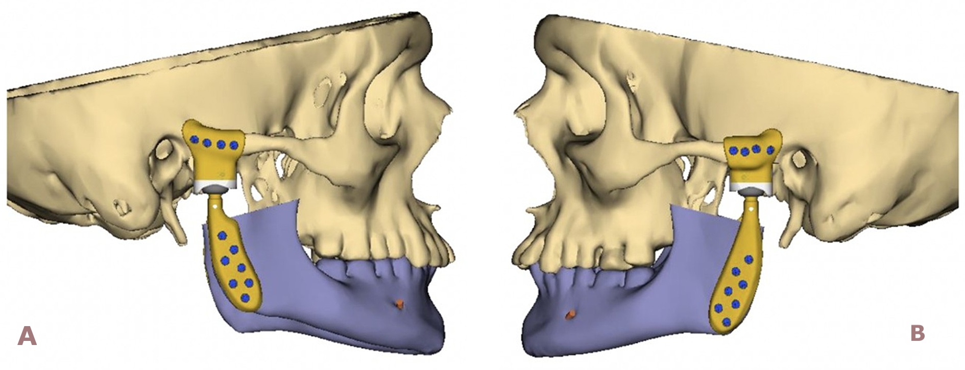 Kiefergelenksrekonstruktion