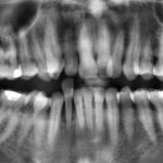 Therapie nach Wurzelamputation mit partieller Pulpotomie