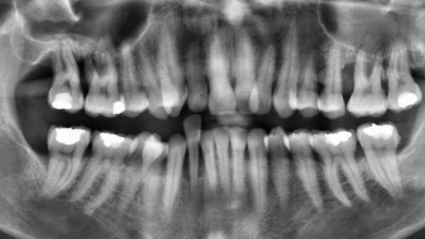 Therapie nach Wurzelamputation mit partieller Pulpotomie