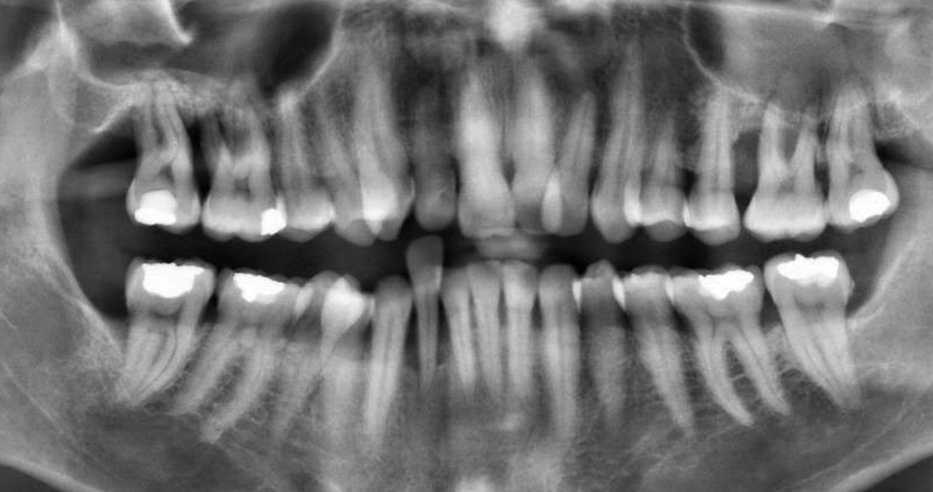 Therapie nach Wurzelamputation mit partieller Pulpotomie