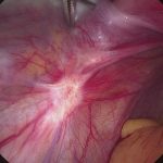 Abb. 2: Laparoskopische Darstellung einer fibrotischen, peritonealen Endometrioseläsion im Bereich des Sacrouterinligaments.