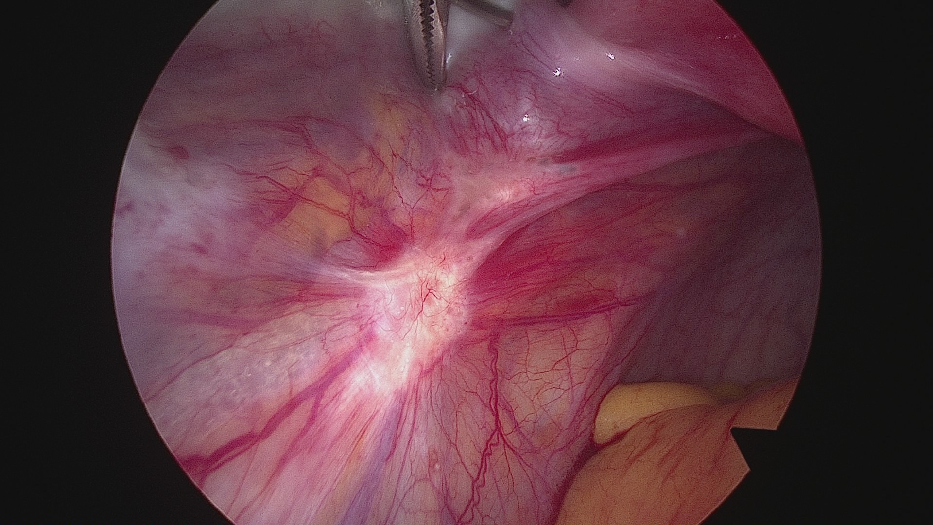 Abb. 2: Laparoskopische Darstellung einer fibrotischen, peritonealen Endometrioseläsion im Bereich des Sacrouterinligaments.