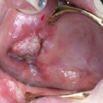 Präzise Diagnostik und moderne Therapie in der Mund-Kiefer-Gesichtschirurgie bei Tumorerkrankungen.