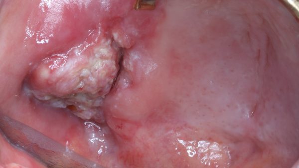 Präzise Diagnostik und moderne Therapie in der Mund-Kiefer-Gesichtschirurgie bei Tumorerkrankungen.