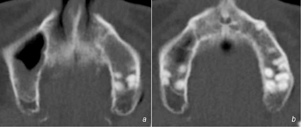 Zahnextraktion: Axiales CT des Oberkiefers bei Erstvorstellung im BwKrhs Berlin: Verschattung des Sinus maxillaris links ohne periapikale Osteolyse