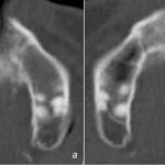 Zahnextraktion: Axiales CT des Oberkiefers bei Erstvorstellung im BwKrhs Berlin: Verschattung des Sinus maxillaris links ohne periapikale Osteolyse