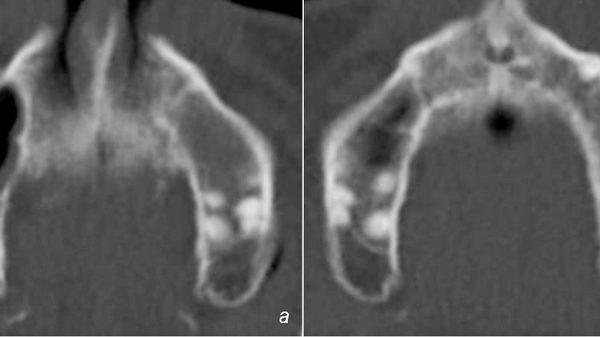 Zahnextraktion: Axiales CT des Oberkiefers bei Erstvorstellung im BwKrhs Berlin: Verschattung des Sinus maxillaris links ohne periapikale Osteolyse