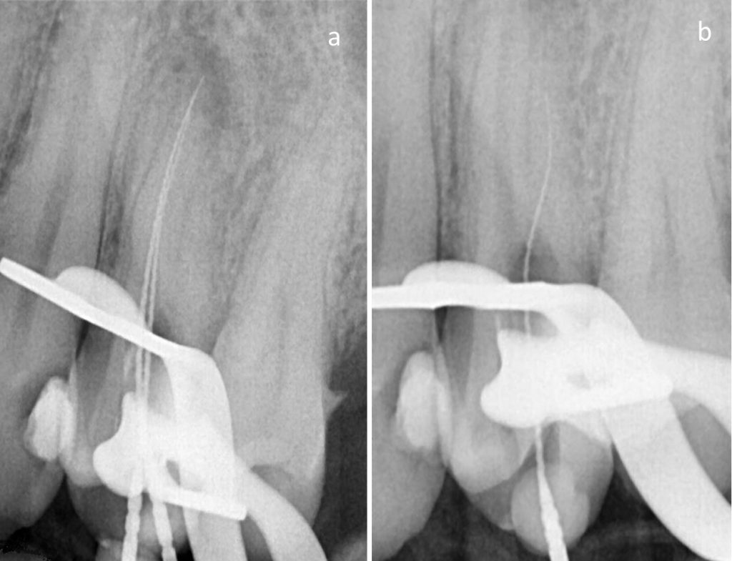 Fallstricke in der Endodontologie