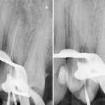 Fallstricke in der Endodontologie