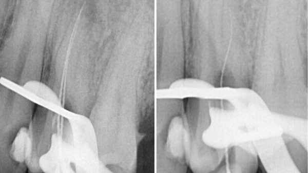 Fallstricke in der Endodontologie
