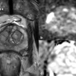 MRT-Diagnostik Abb. 1: MRT der Prostata (a) T2-Wichtung der Prostata eines Patienten mit elevierten Werten des Prostataspezifischen Antigens. Mit Pfeil ist die suspekte PI-RADS-4-Läsion (Prostate Imaging-Reporting and Data System) in der rechten peripheren Zone der Prostata markiert. Die MRT-fusionierte Stanzbiopsie ergab ein klinisch signifikantes Karzinom Gleason-Score von 3+4 =7. (b) entsprechende Läsion hyperintens in der Diffusionswichtung. (c) entsprechende Läsion deutlich hypointens in der ADC (Apparent Diffusion Coefficient) Sequenz mit minimalen ADC-Werten von 480 mm2/s.