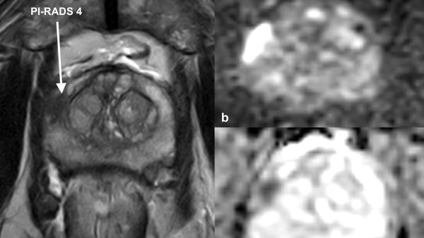 MRT-Diagnostik Abb. 1: MRT der Prostata (a) T2-Wichtung der Prostata eines Patienten mit elevierten Werten des Prostataspezifischen Antigens. Mit Pfeil ist die suspekte PI-RADS-4-Läsion (Prostate Imaging-Reporting and Data System) in der rechten peripheren Zone der Prostata markiert. Die MRT-fusionierte Stanzbiopsie ergab ein klinisch signifikantes Karzinom Gleason-Score von 3+4 =7. (b) entsprechende Läsion hyperintens in der Diffusionswichtung. (c) entsprechende Läsion deutlich hypointens in der ADC (Apparent Diffusion Coefficient) Sequenz mit minimalen ADC-Werten von 480 mm2/s.