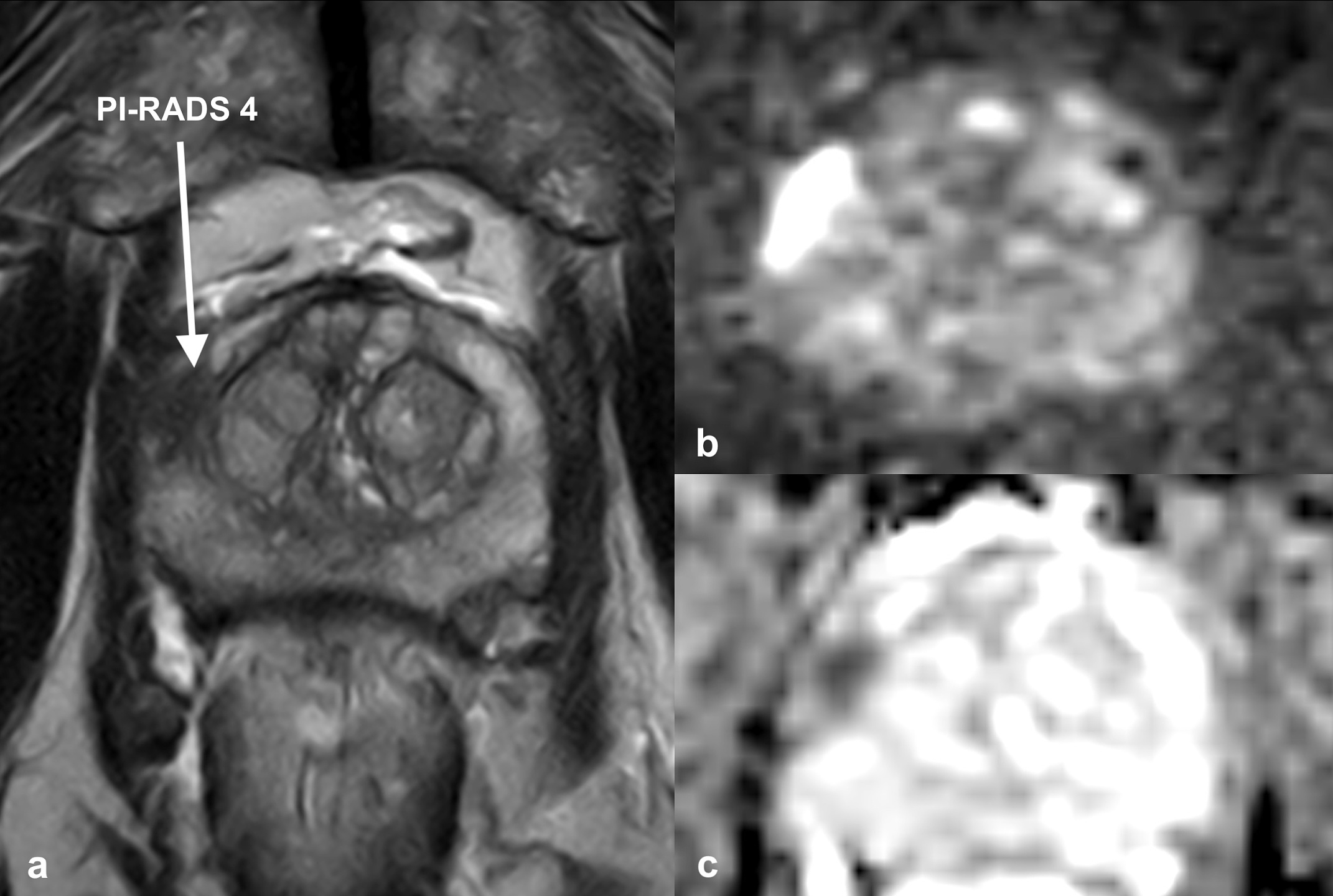 MRT-Diagnostik Abb. 1: MRT der Prostata (a) T2-Wichtung der Prostata eines Patienten mit elevierten Werten des Prostataspezifischen Antigens. Mit Pfeil ist die suspekte PI-RADS-4-Läsion (Prostate Imaging-Reporting and Data System) in der rechten peripheren Zone der Prostata markiert. Die MRT-fusionierte Stanzbiopsie ergab ein klinisch signifikantes Karzinom Gleason-Score von 3+4 =7. (b) entsprechende Läsion hyperintens in der Diffusionswichtung. (c) entsprechende Läsion deutlich hypointens in der ADC (Apparent Diffusion Coefficient) Sequenz mit minimalen ADC-Werten von 480 mm2/s.