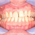 Zahnerhaltung: Klinischer intraoraler Aspekt