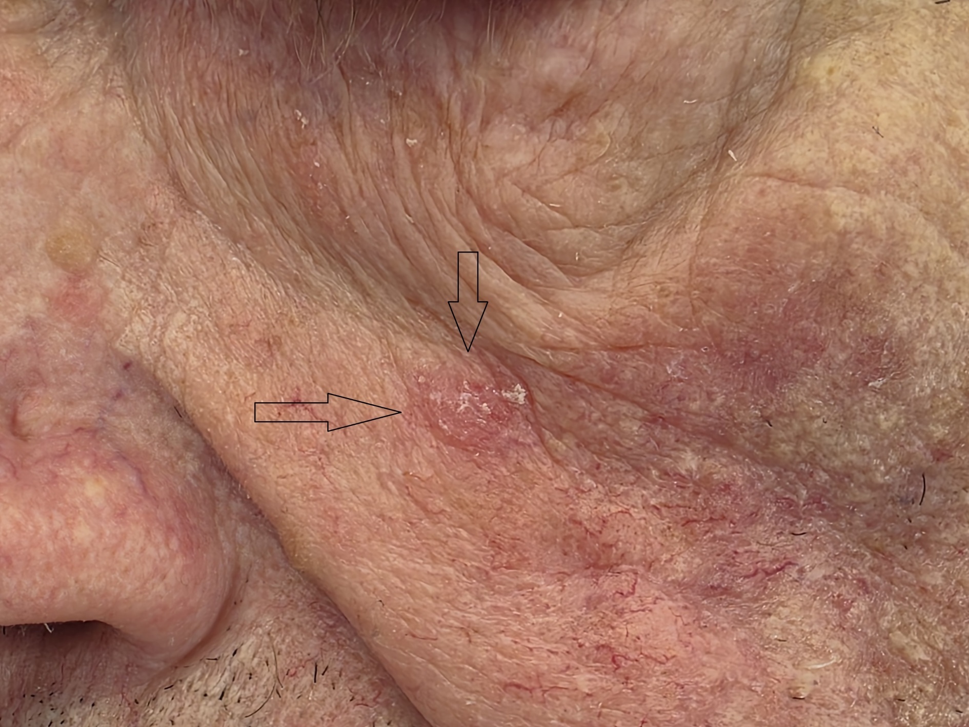 Abb. 1: Aktinische Keratose Grad II an der Wange