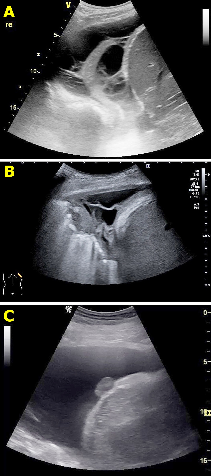 Abb. 4: Beispiele komplizierter Pleuraergüsse: (a) multipel septierter Erguss bei Pleuraempyem (b) pleurale Auflagerungen und Septen bei tuberkulöser Pleuritis (c) solider Pleuraknoten bei Pleurakarzinose