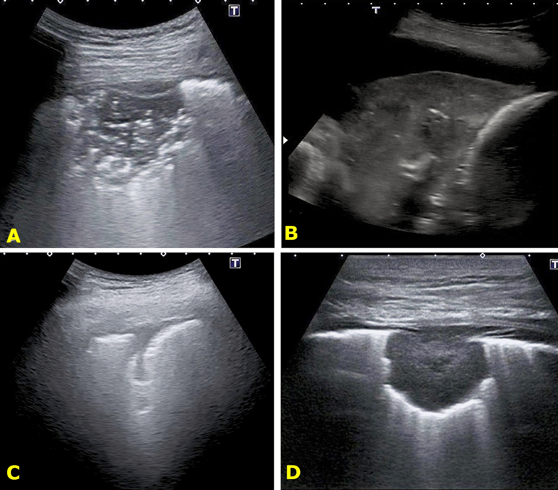 Abb. 5: Beispiele pulmonaler Konsolidierungen: (a) Pneumonie (b) Lungenatelektase (c) Lungeninfarkt bei Lungenembolie (d) Lungenmetastase