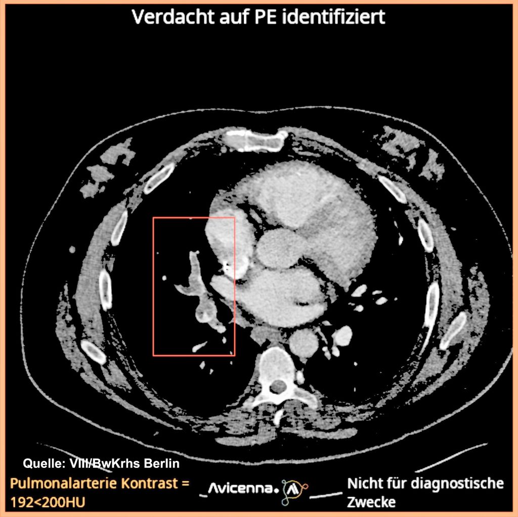 Markierung einer Lungenarterienembolie bei Rechtsherzbelastung und entsprechend eingeschränkter Herzkreislaufzeit: Die hohe Thrombuslast wird zuverlässig markiert. Die Berechnung erforderte weniger als zwei Minuten.
