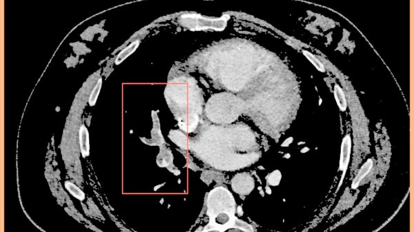 Markierung einer Lungenarterienembolie bei Rechtsherzbelastung und entsprechend eingeschränkter Herzkreislaufzeit: Die hohe Thrombuslast wird zuverlässig markiert. Die Berechnung erforderte weniger als zwei Minuten.