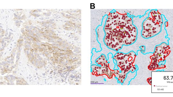 Abb. 2: (A) Immunhistochemische Färbung auf PD-L1 am Gewebeschnitt eines Lungenkarzinoms; (B) KI-gestützte Bestimmung des PD-L1 Tumor Proportion Score (TPS; Verhältnis zwischen PD-L1-positiven Tumorzellen und der Gesamtzahl der Tumorzellen) durch die Software Mindpeak.