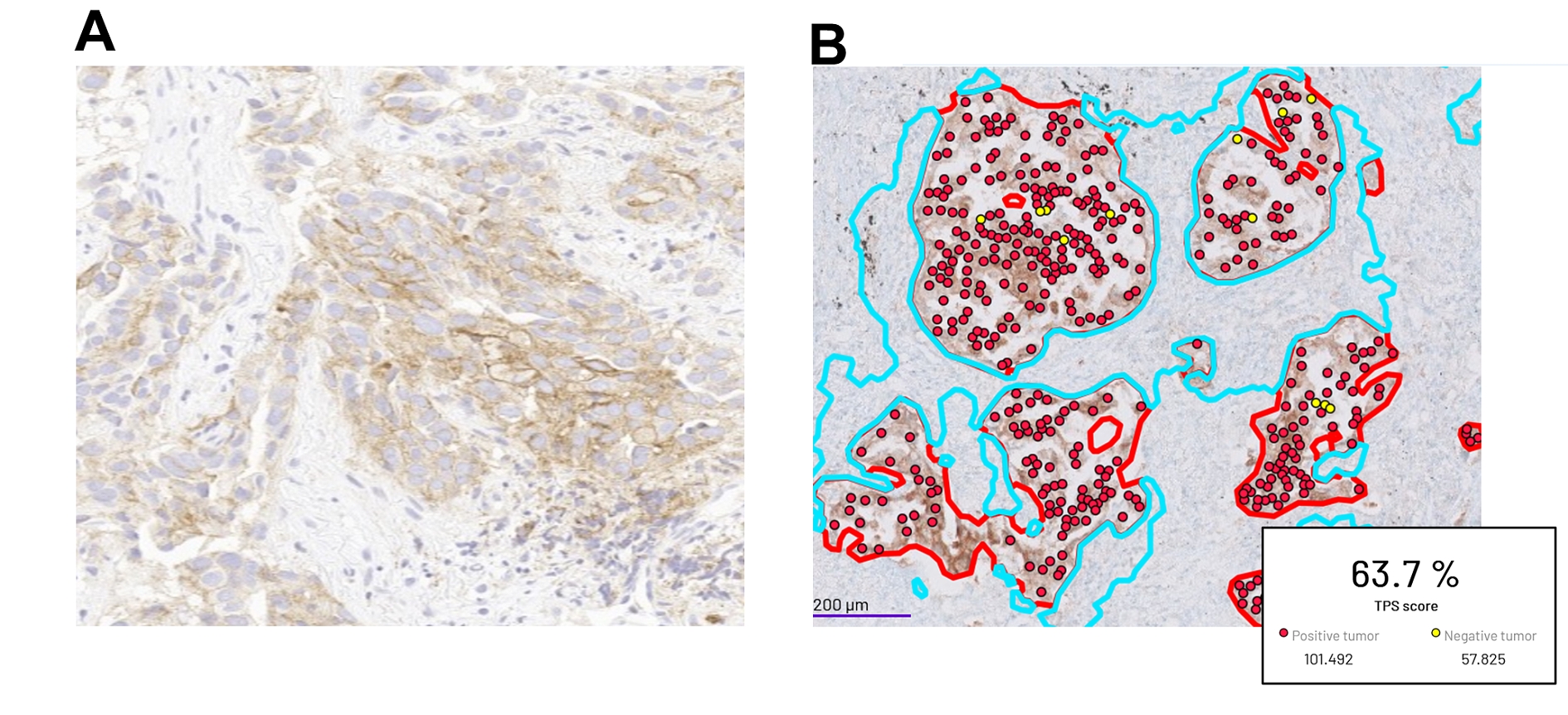 Abb. 2: (A) Immunhistochemische Färbung auf PD-L1 am Gewebeschnitt eines Lungenkarzinoms; (B) KI-gestützte Bestimmung des PD-L1 Tumor Proportion Score (TPS; Verhältnis zwischen PD-L1-positiven Tumorzellen und der Gesamtzahl der Tumorzellen) durch die Software Mindpeak.