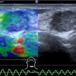 Abb. 3: Pathologischer Befund in der transienten Elastografie eines verhärteten cervicalen Lymphknotens, hier bei Metastase durch ein Nierenzellkarzinom