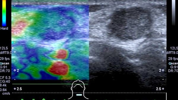 Abb. 3: Pathologischer Befund in der transienten Elastografie eines verhärteten cervicalen Lymphknotens, hier bei Metastase durch ein Nierenzellkarzinom