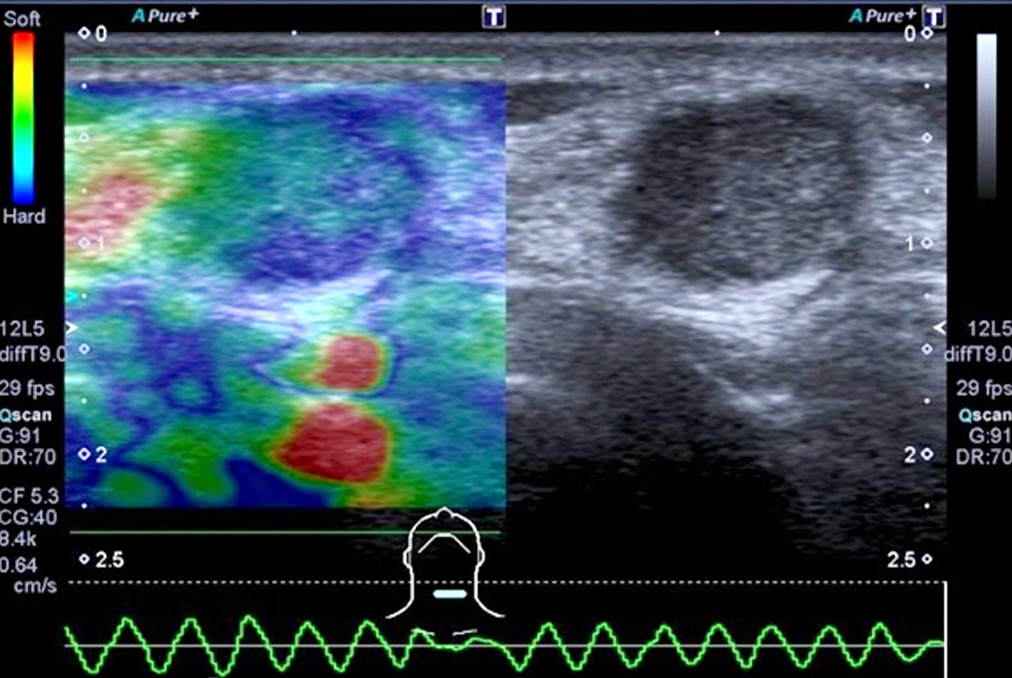 Abb. 3: Pathologischer Befund in der transienten Elastografie eines verhärteten cervicalen Lymphknotens, hier bei Metastase durch ein Nierenzellkarzinom