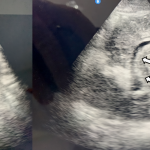 Abb. 1: Ultraschall zeigt Periportale Fibrose (Pfeile): POCUS bei einem Patienten mit Z.n. Ösophagusvarizenblutung, Kilimanjaro Region, Tansania