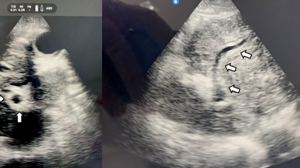 Abb. 1: Ultraschall zeigt Periportale Fibrose (Pfeile): POCUS bei einem Patienten mit Z.n. Ösophagusvarizenblutung, Kilimanjaro Region, Tansania