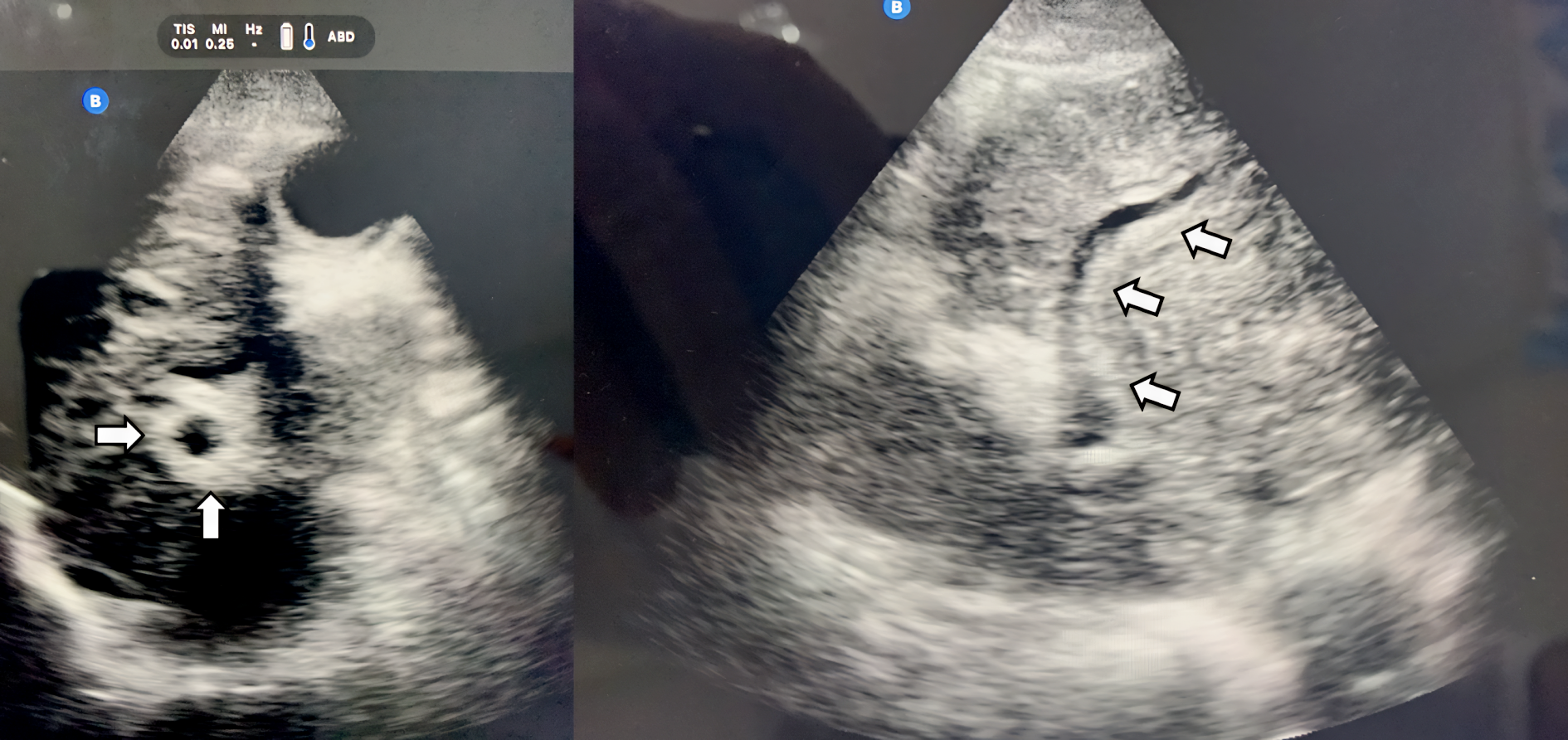 Abb. 1: Ultraschall zeigt Periportale Fibrose (Pfeile): POCUS bei einem Patienten mit Z.n. Ösophagusvarizenblutung, Kilimanjaro Region, Tansania