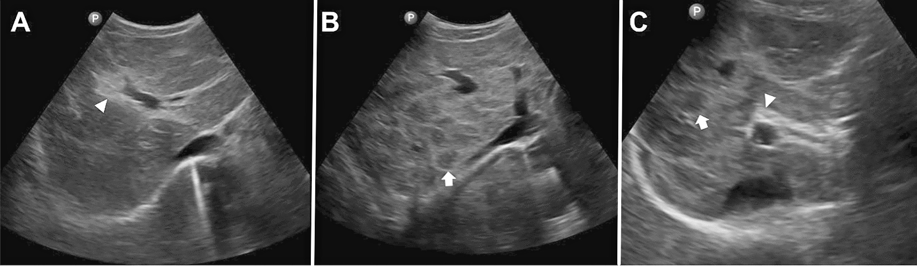 Abb. 2: Fibrosemuster (Pfeile) bei Schistosoma japonicum: (A) Periportale Fibrose; (B) interseptale Fibrose; (C) gleichzeitig vorliegende portale und interseptale Fibrose.