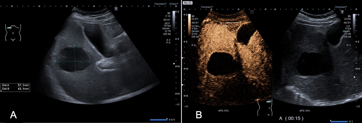 Abb. 3: (A) B-Bild mit großer, scharf begrenzter, relativ homogener, echoarmer Läsion bei Amöbenleberabszess. (B) Arterielle Phase im CEUS bei Amöbenleberabszess mit hyperämem Randsaum und zentraler Kontrastaussparung