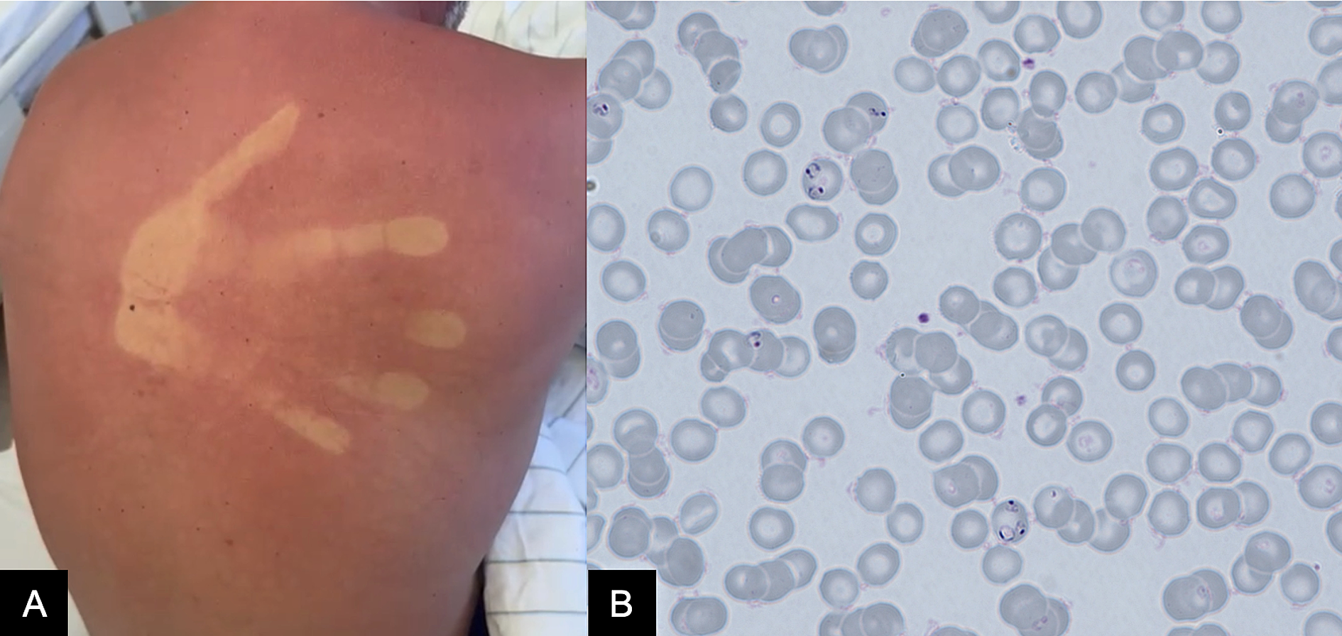 Abb. 4: (A) Handabdruck als Dermografismus, z. B. bei Dengue (B) Plasmodium falciparum, Blutausstrich bei Malaria tropica. Beide Erkrankungen sind relevante Differenzialdiagnosen bei fieberhaften Patienten in und aus Endemiegebieten.