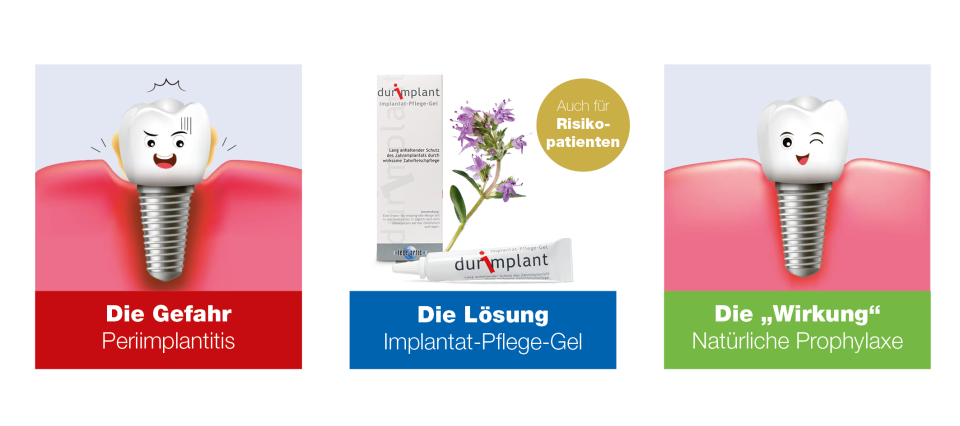 Implantate natürlich erhalten und pflegen – mit durimplant